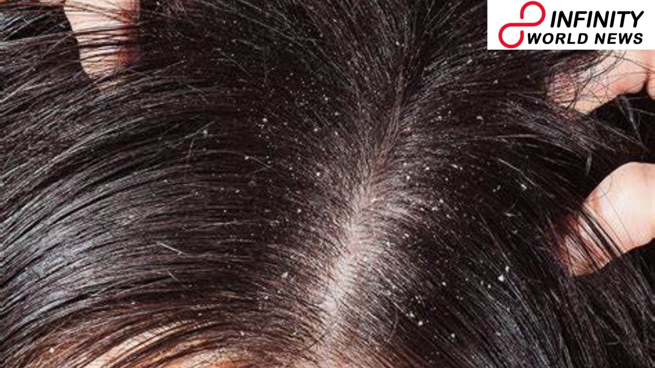 9 Dermatologist-Backed Ideas to Stop Dandruff Efficiently